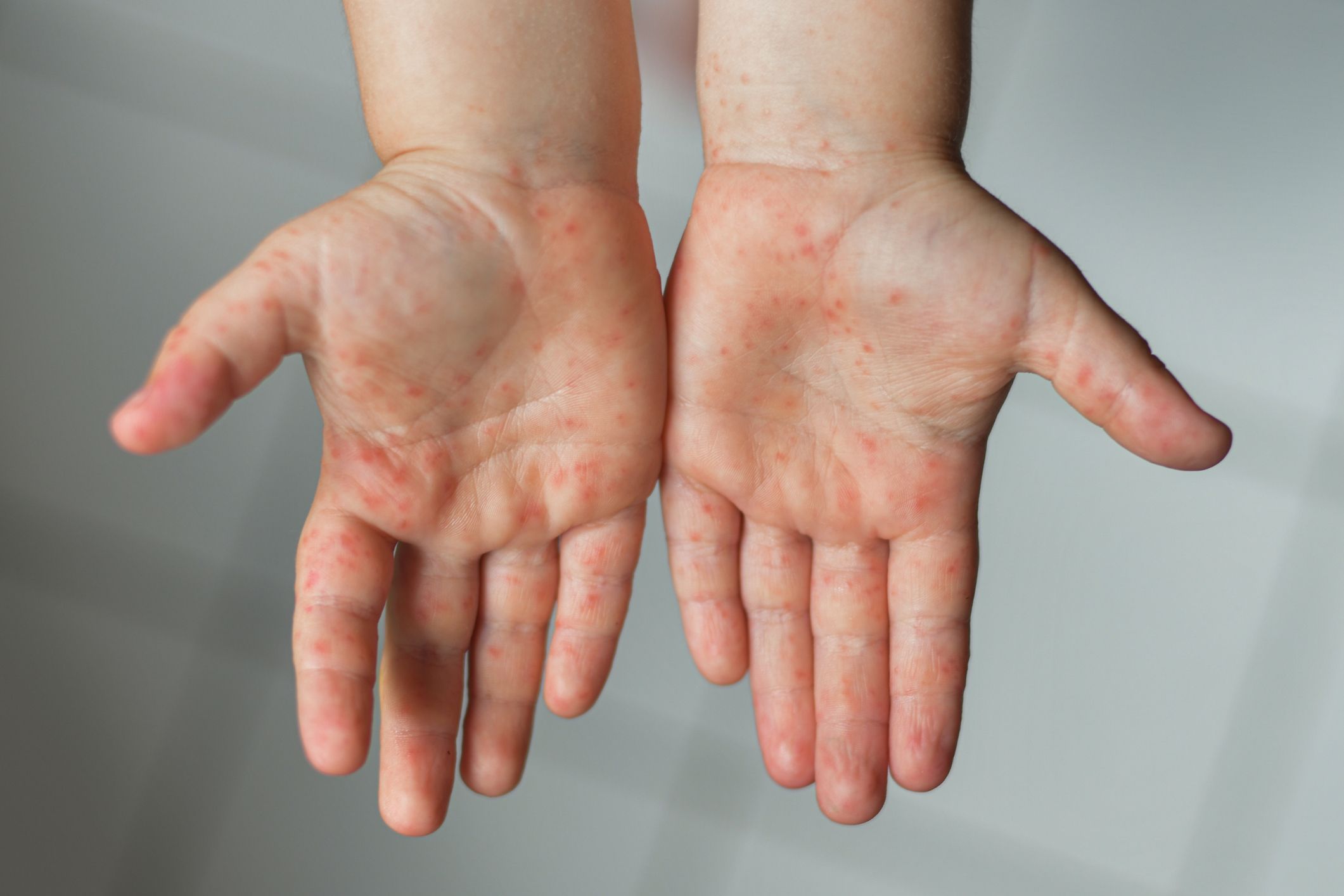 Hände mit Hand-Fuß-Mund-Krankheit