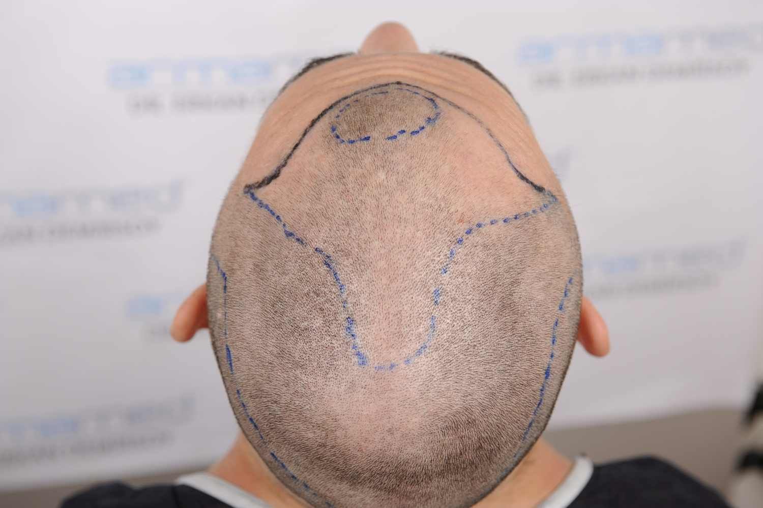 Haartransplantation: Vor der OP