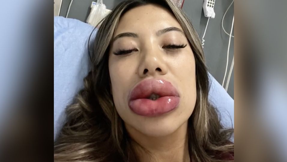 Albtraum-Ergebnis - Frau will sich "nur etwas" die Lippen aufspritzen lassen – und landet in der Notaufnahme