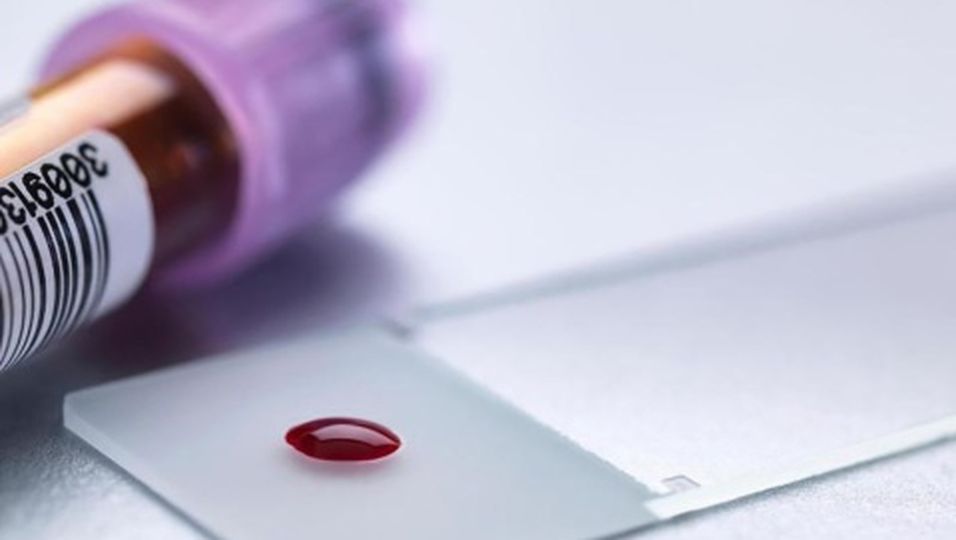 Sensation: Neuer Test erkennt Brustkrebs im Blut