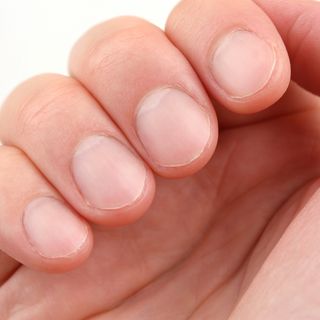 Nagelpilz Pilzerkrankungen Der Nagel Erkennen Behandeln Und Vorbeugen Bunte De