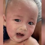 Konnte nicht aufhören, sich vor Schmerzen zu kratzen und zu weinen - Baby leidet monatelang an Ausschlag – bis gespendete Muttermilch Oscar von seinen Qualen befreite
