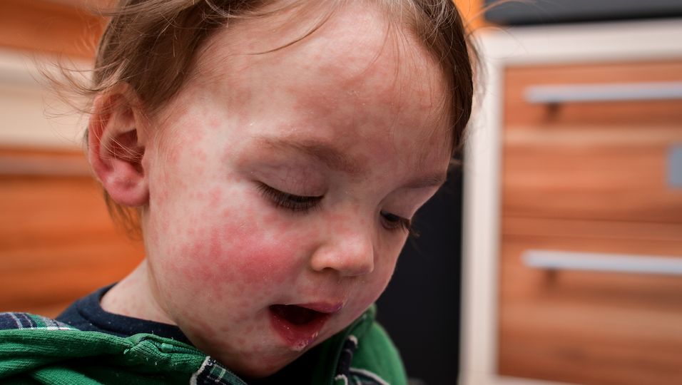 Mutter warnt Eltern eindringlich:  Einjähriger wacht mit "Horror-Ausschlag" auf – wenig später blutet er aus Nase und Mund