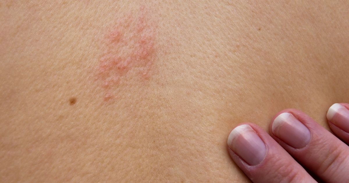 Virusinfektion Gürtelrose Ursachen und Symptome BUNTE.de